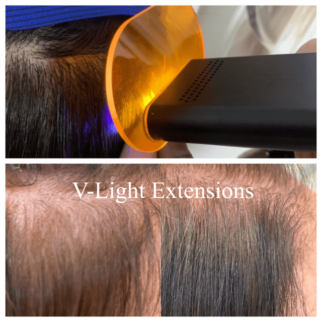 V- lights Extensions